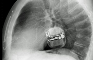 Röntgenbild på en inopererad hjärtstartare, ICD